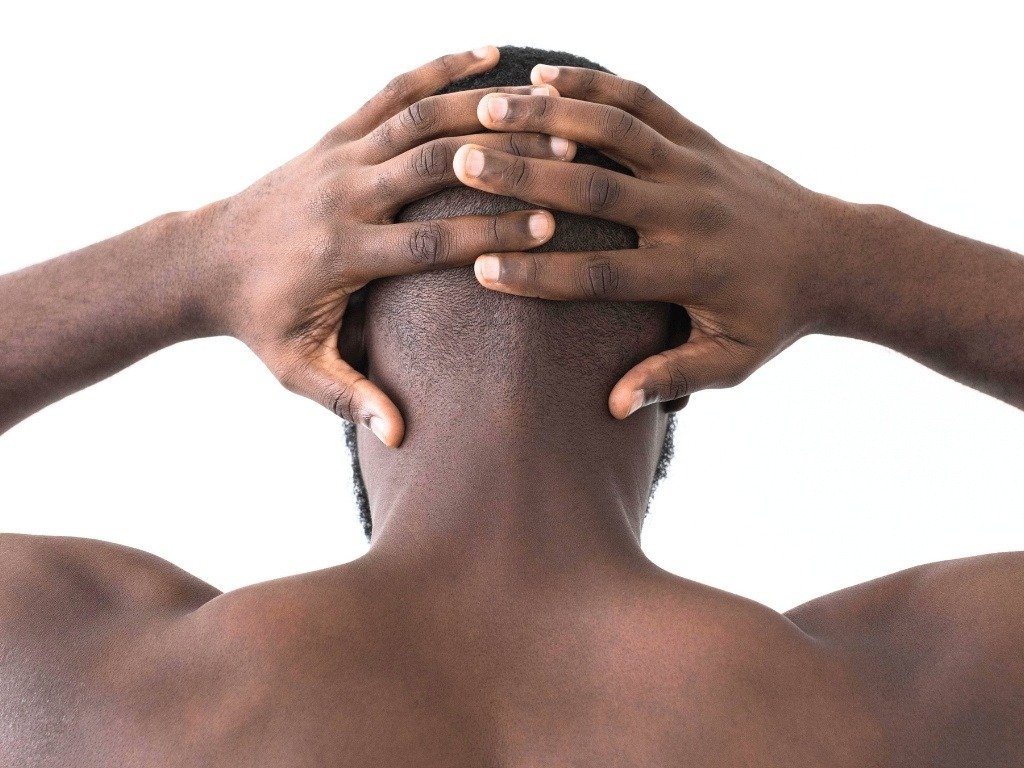 Alopecia areata